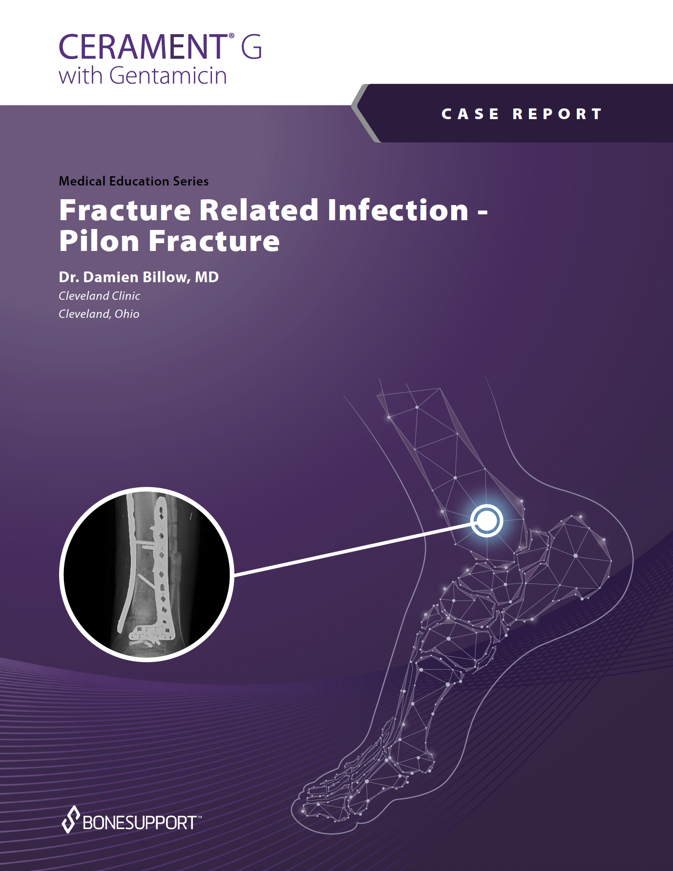 Fracture Related Infection – Pilon Fracture